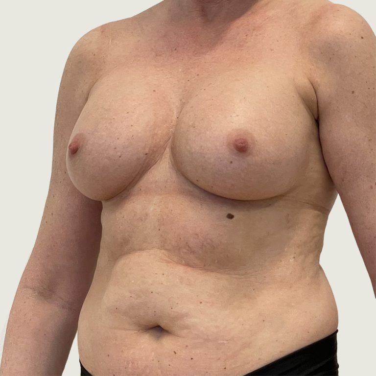 Before Replacement of Implants with Own Fat from side