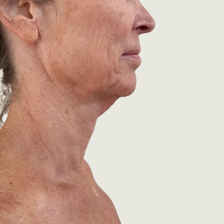 Renuvion facial skin tightening after