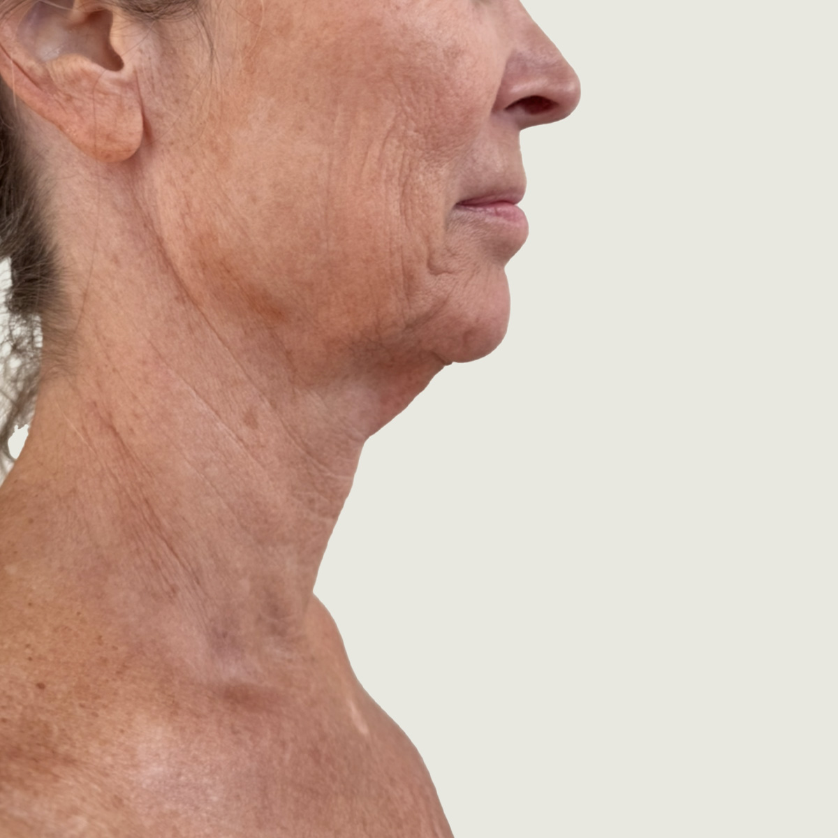 Renuvion facial skin tightening after