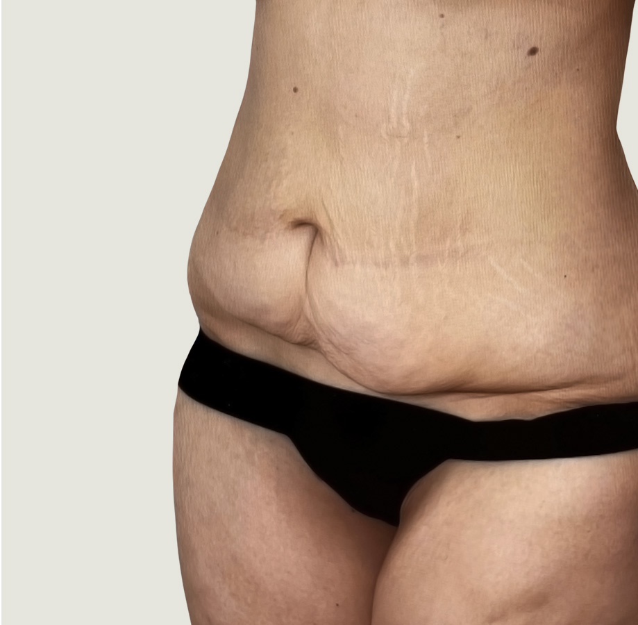 Tummy tuck before