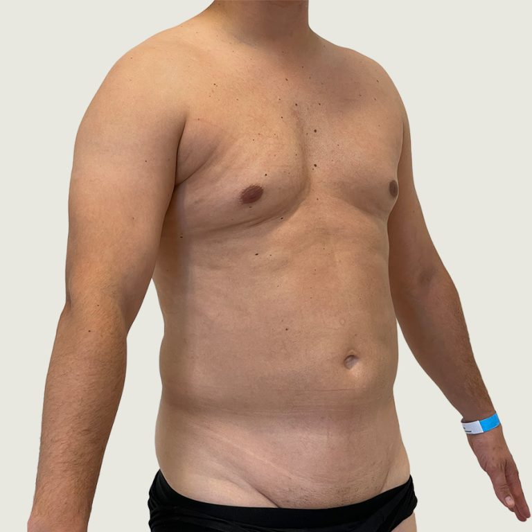 Before man body conturing