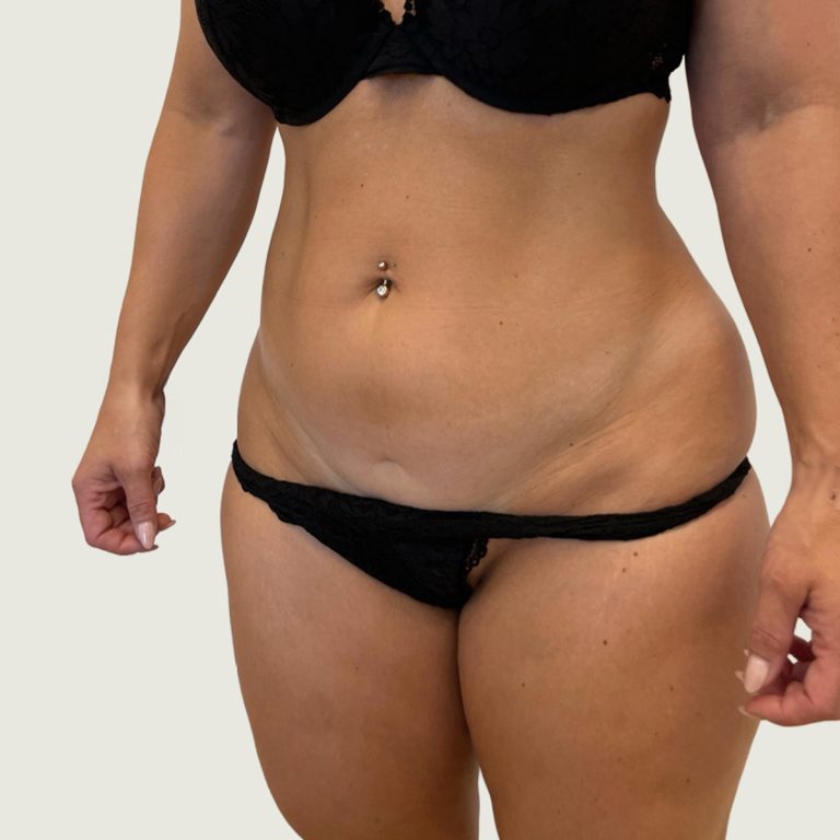 Before BodyConturing high def