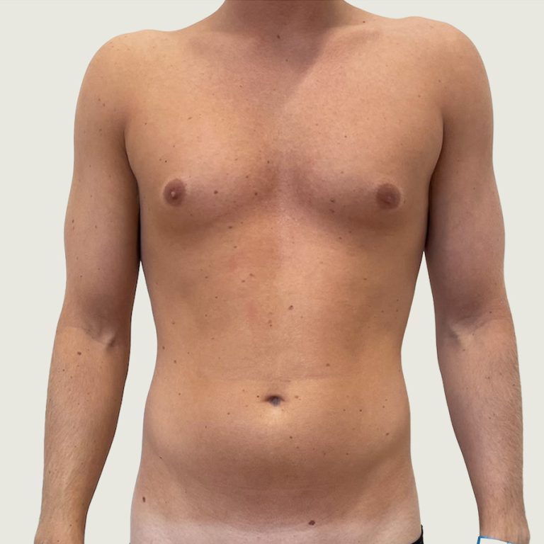 Before man body conturing