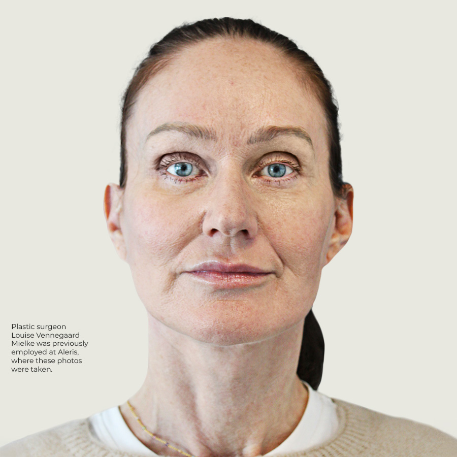 After Deep plane face and neck lift + ponytail lift