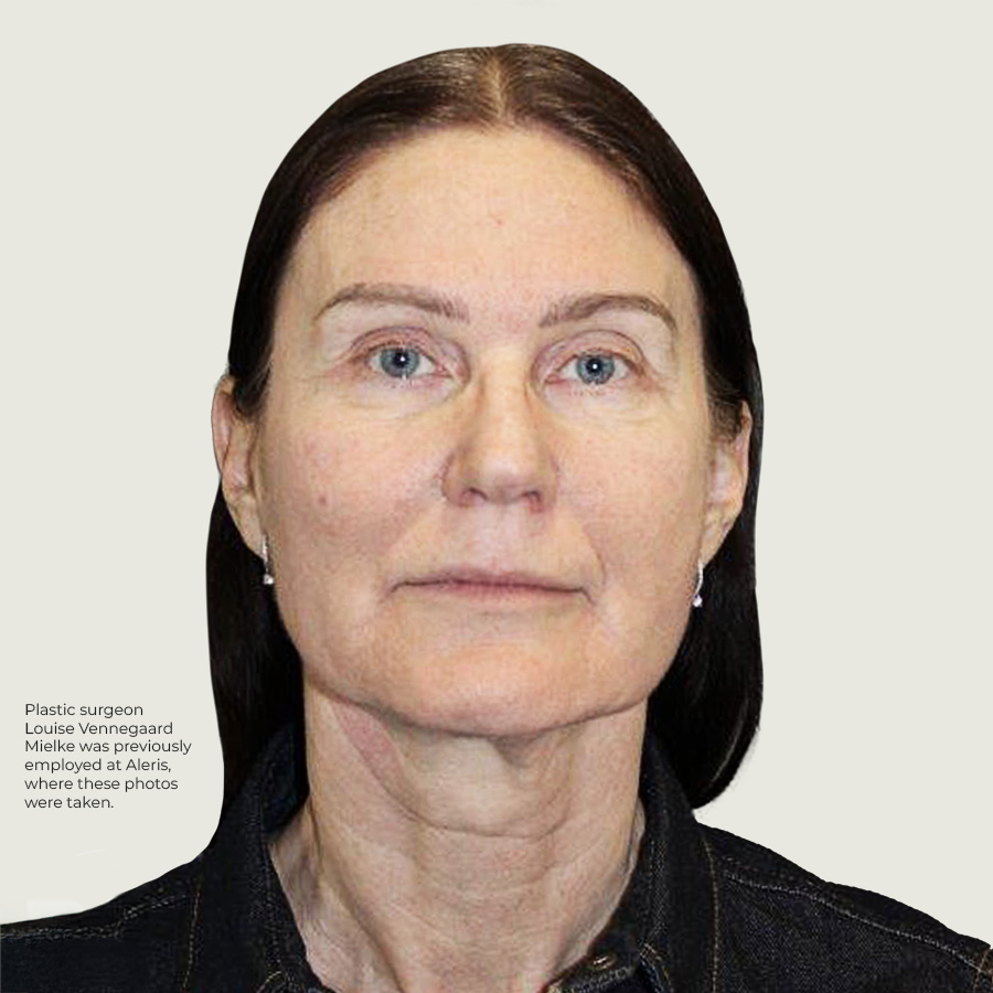 Before Deep plane face and neck lift + ponytail lift