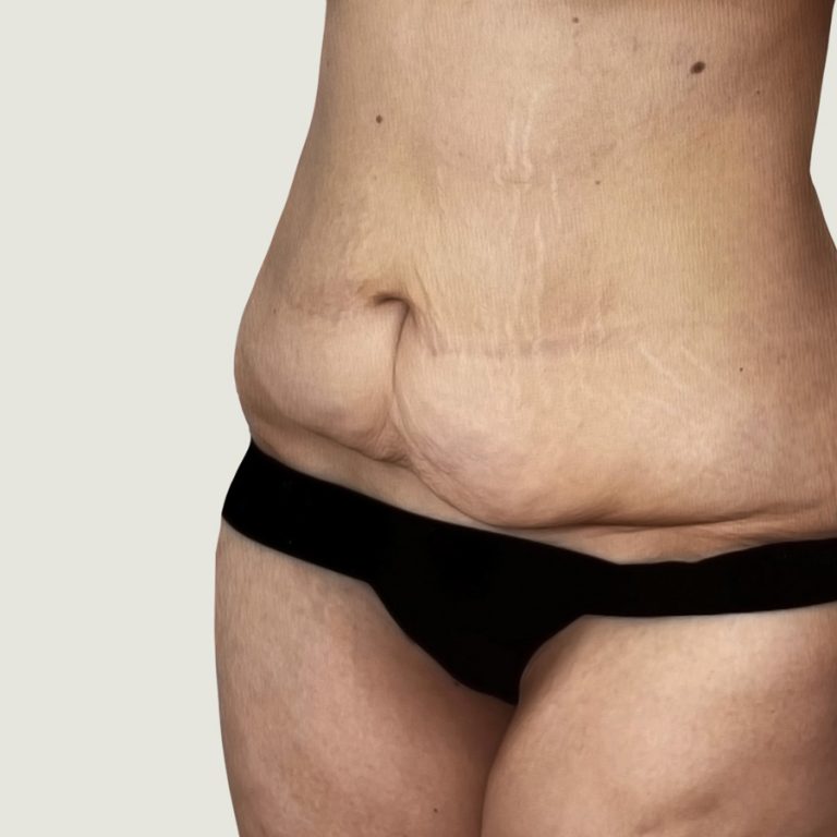 Before BodyConturing high def