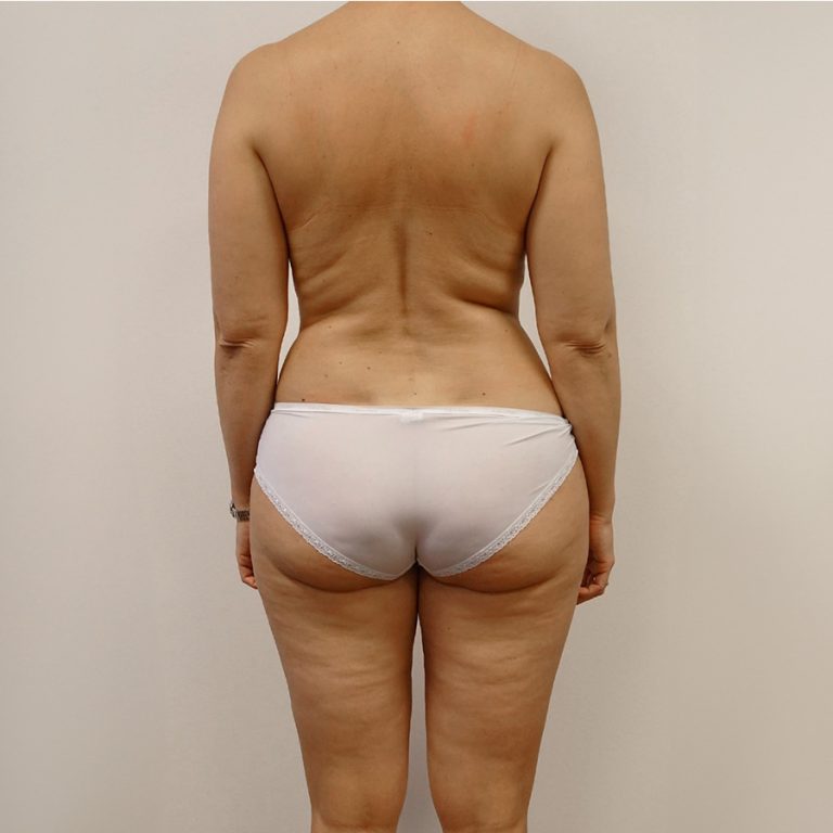 Before Body Contouring from behind