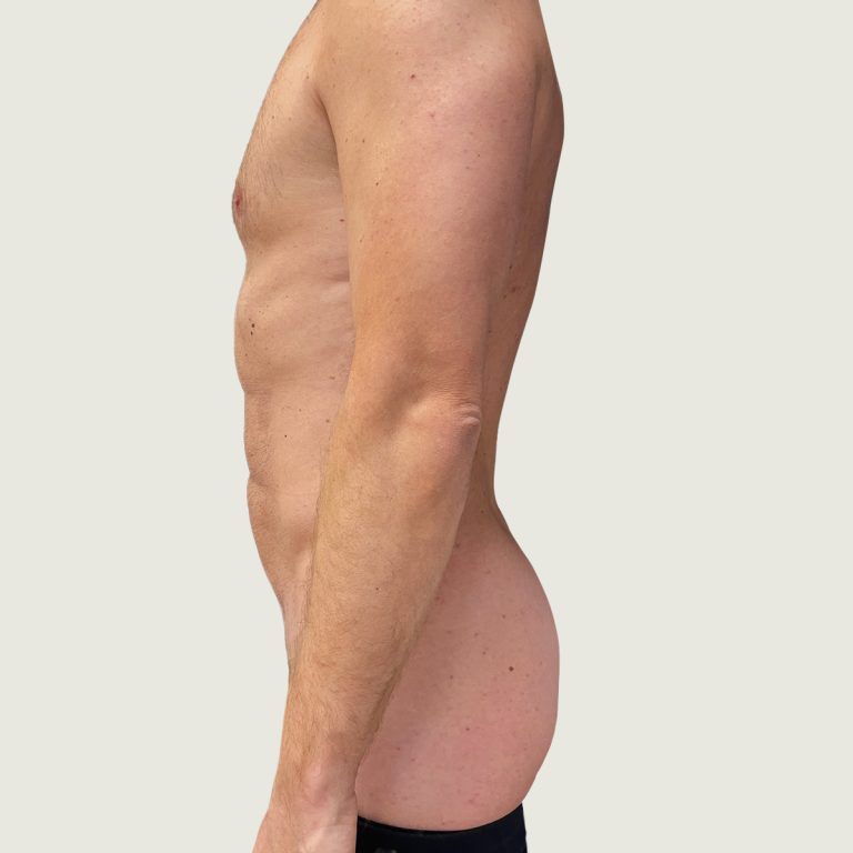 BodyConturing before after