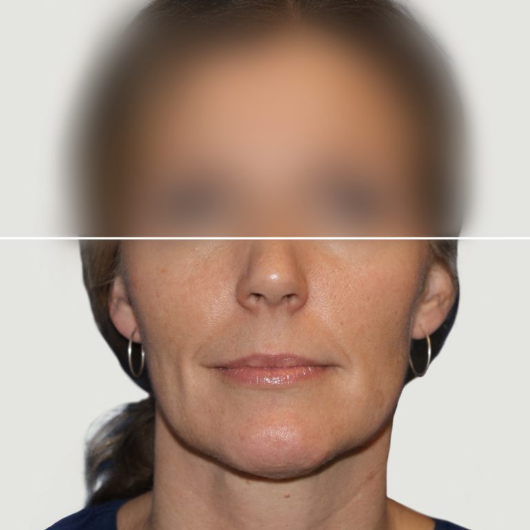 After Lipofilling for correction of volume and skin quality