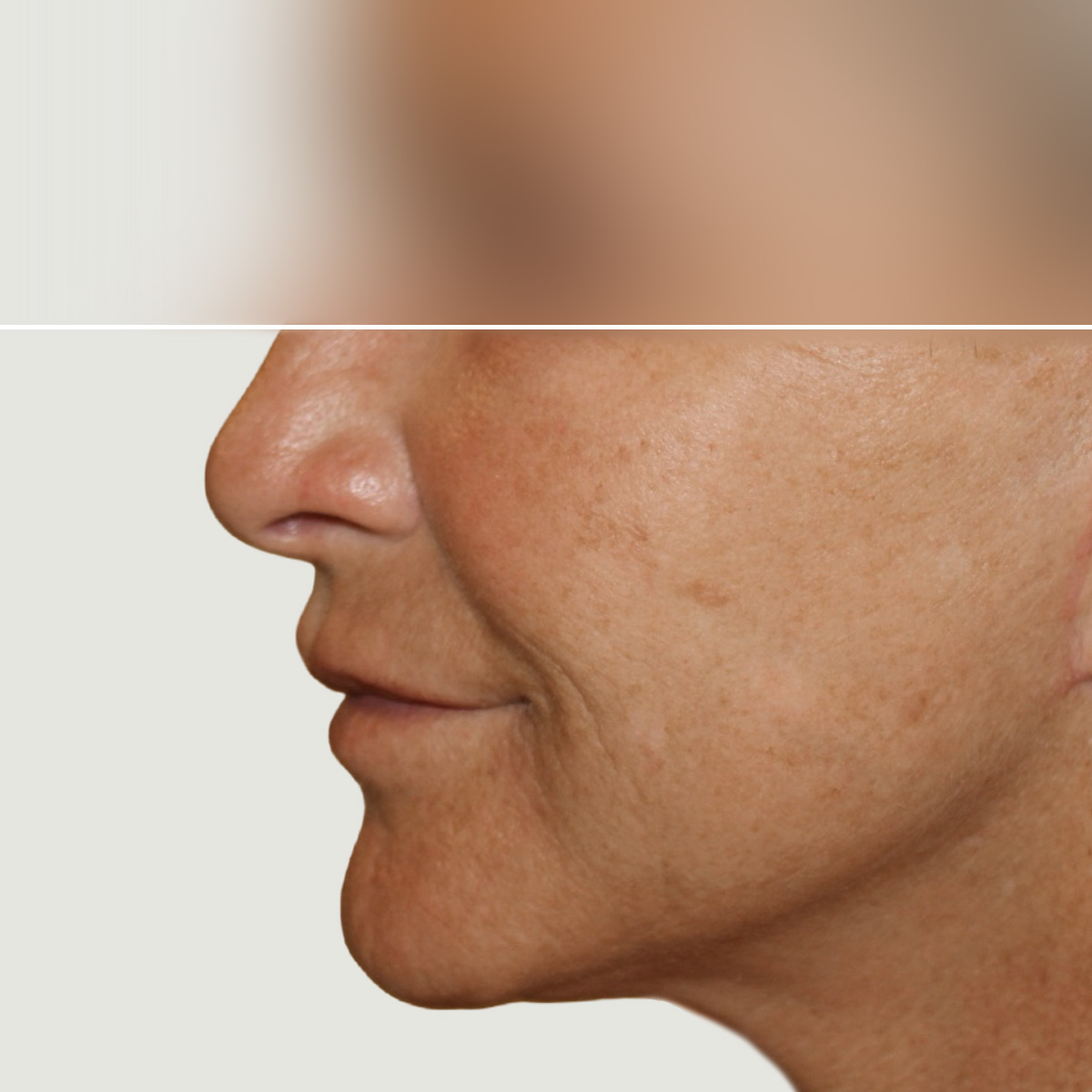 Lipofilling for correction of volume and skin quality