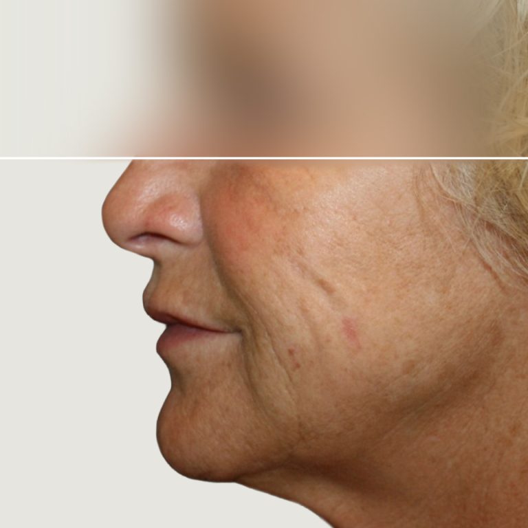 Before Lipofilling for correction of volume and skin quality