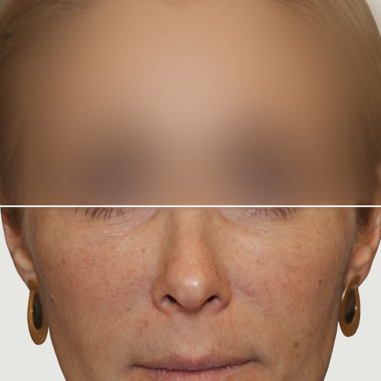 After Lipofilling for correction of volume and skin quality