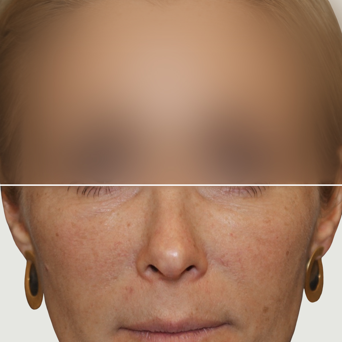 After Lipofilling for correction of volume and skin quality