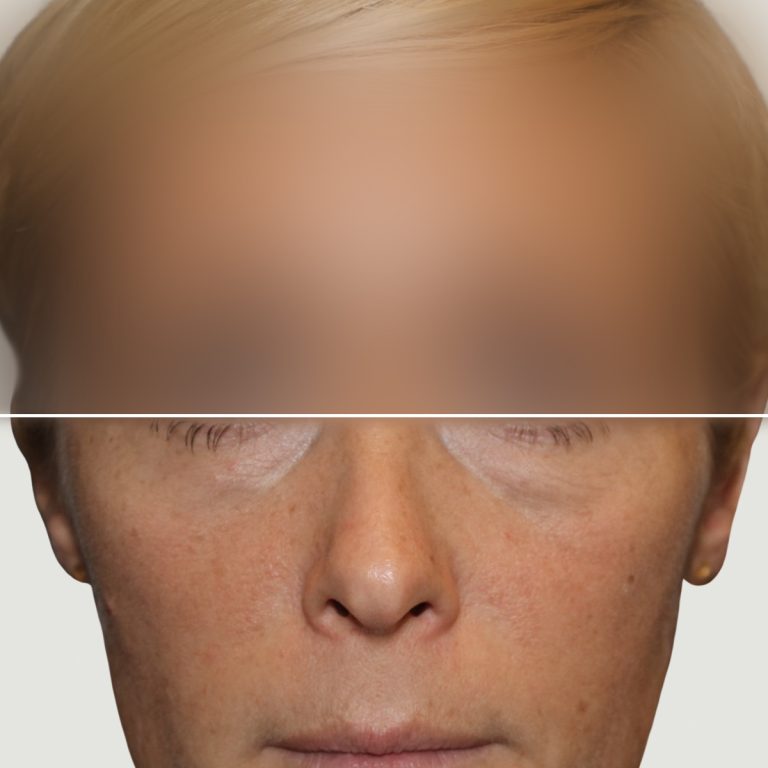 Before Lipofilling for correction of volume and skin quality