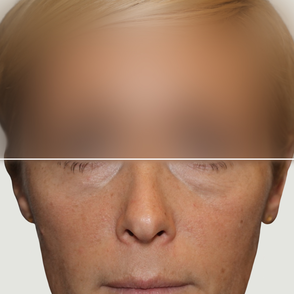 Before Lipofilling for correction of volume and skin quality