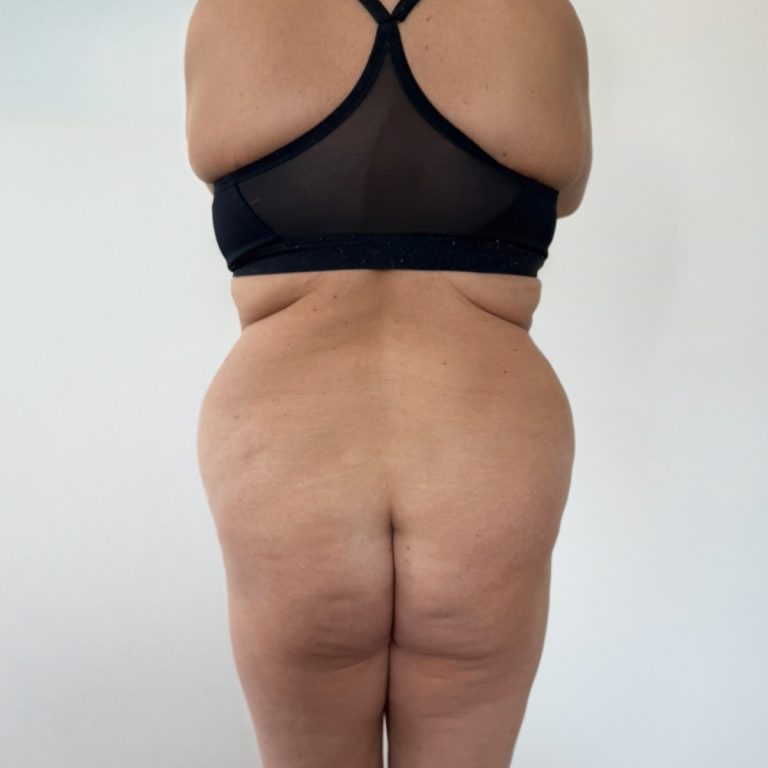 Before Body Contouring