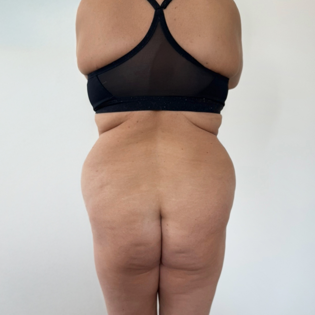 Before Body Contouring