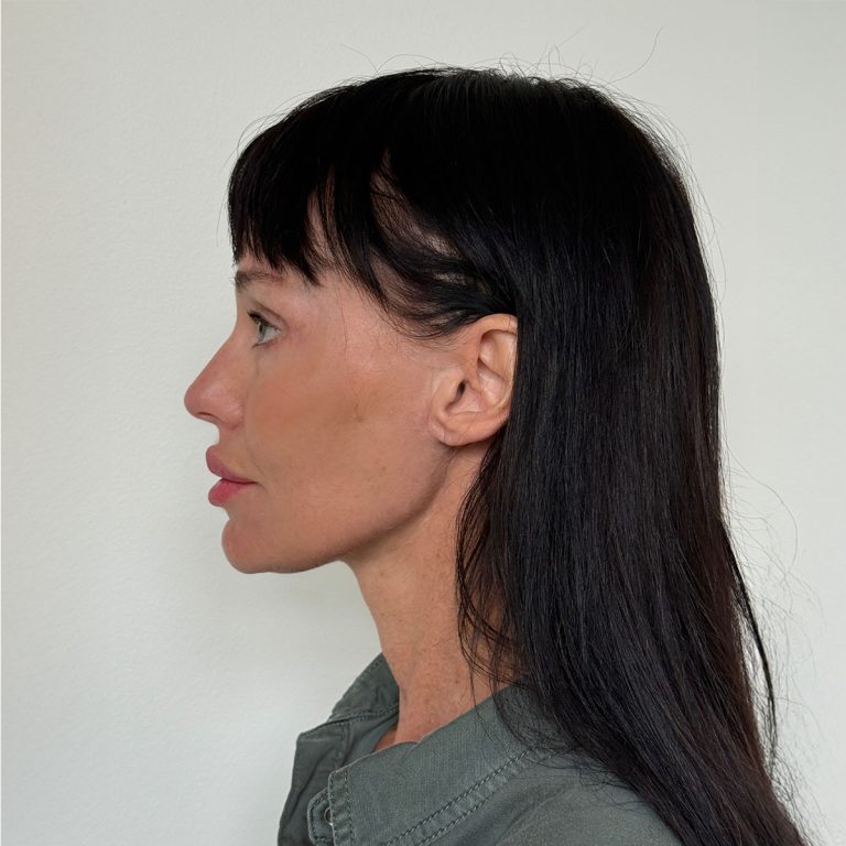 After Deep plane facelift