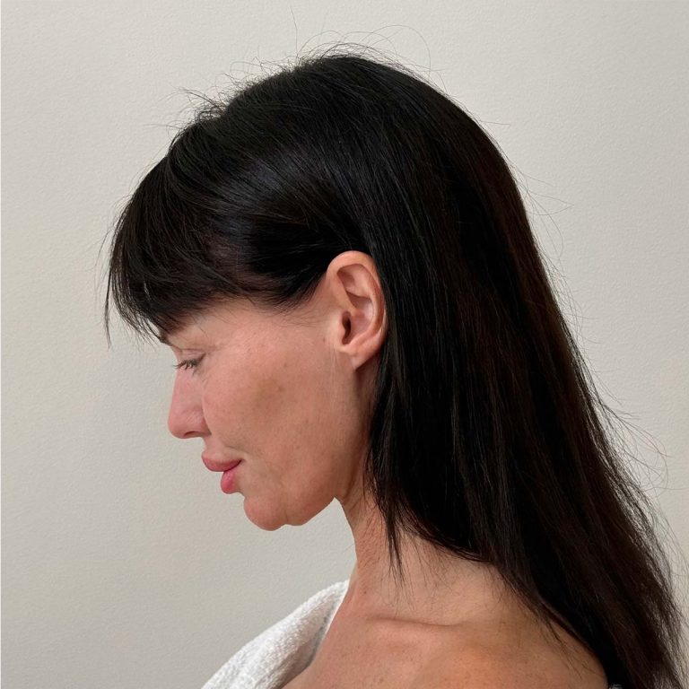 Before Deep plane facelift