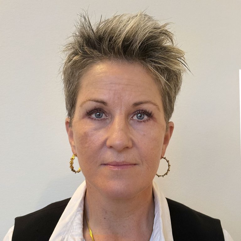 After Deep plane facelift and Deep plane necklift