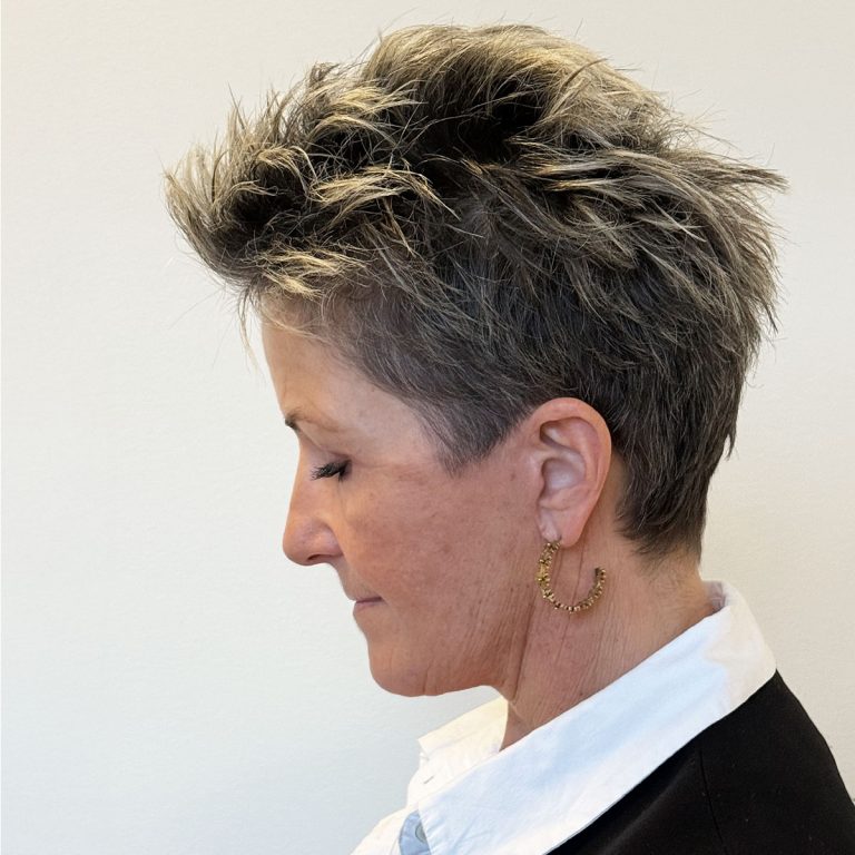 After Deep plane facelift and Deep plane necklift