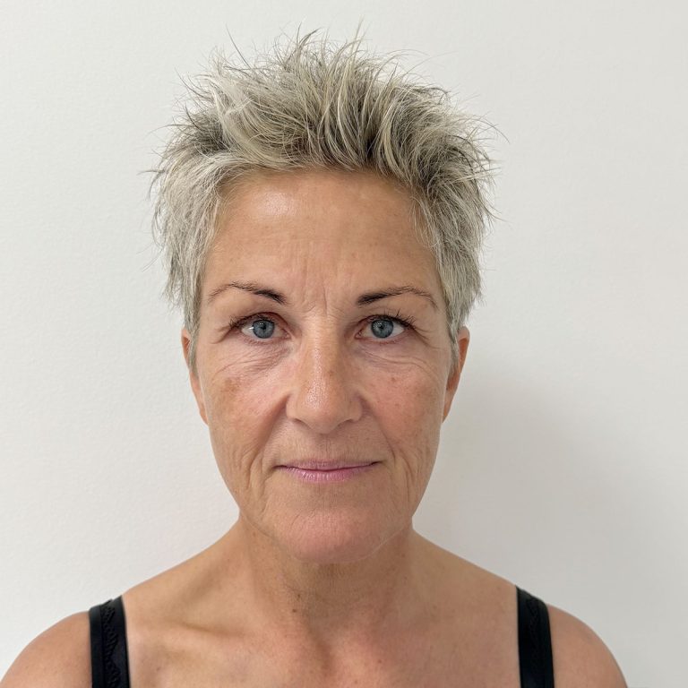 Before Deep plane facelift og Deep plane necklift