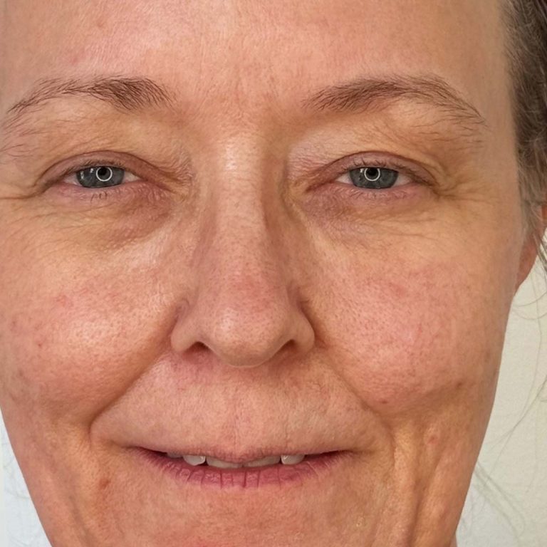 Before eyelid surgery profil