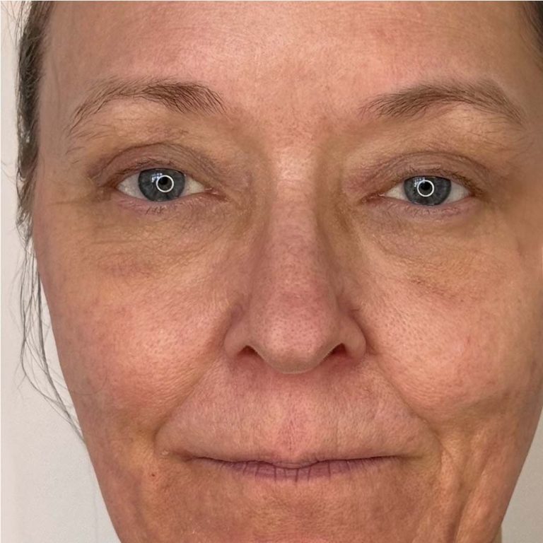 After eyelid surgery profil