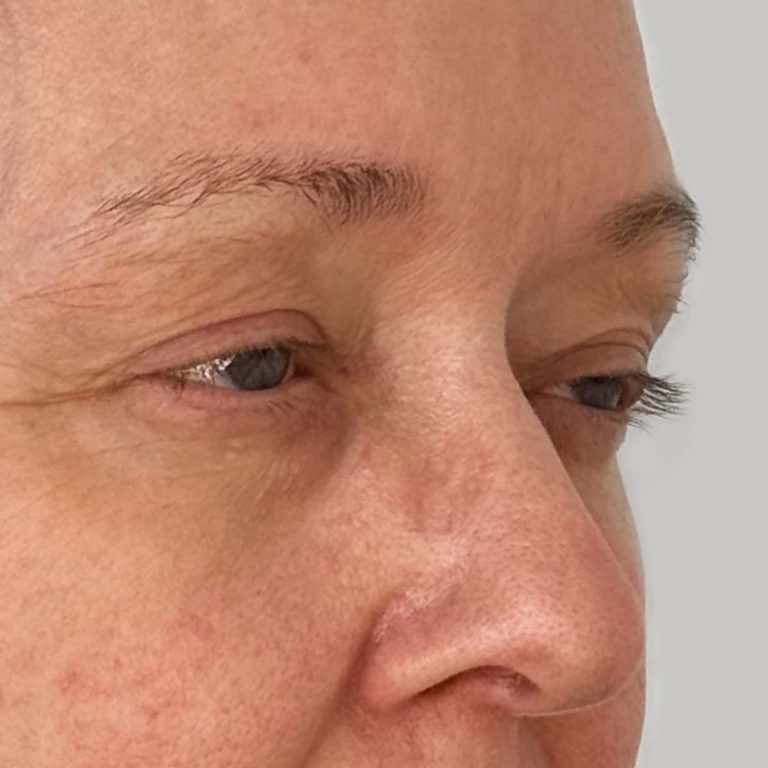 Before eyelid surgery side