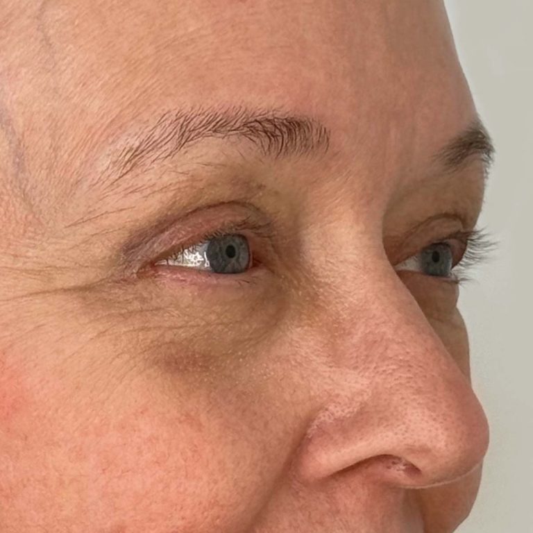 After eyelid surgery side