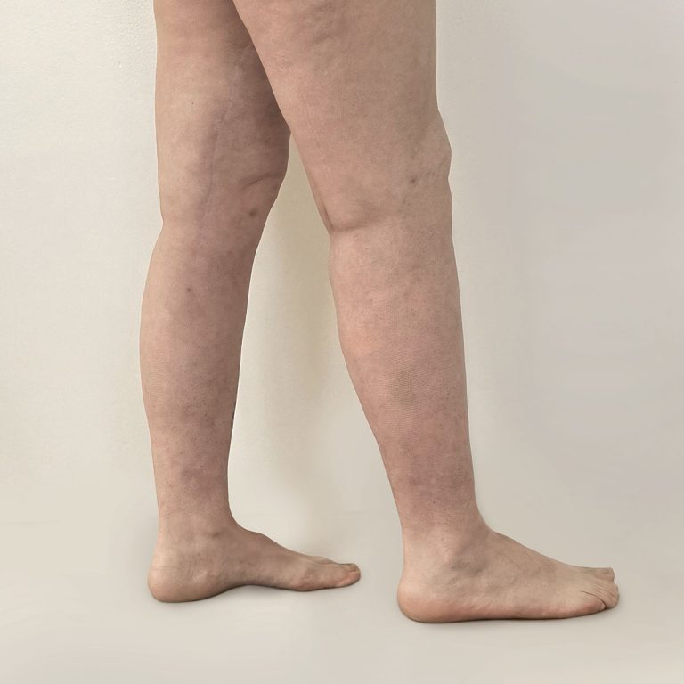 After Lipedema legs from side