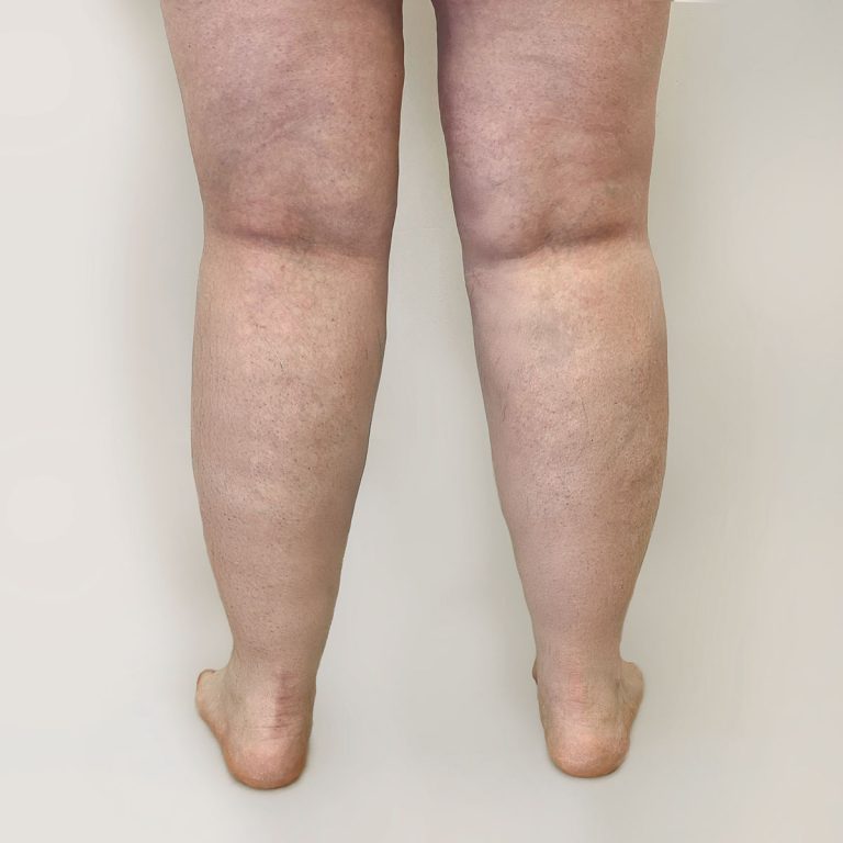 Before Lipedema legs from behind