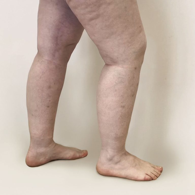 Before Lipedema legs from side