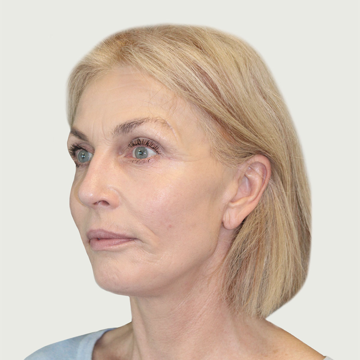 Deep plane necklift efter