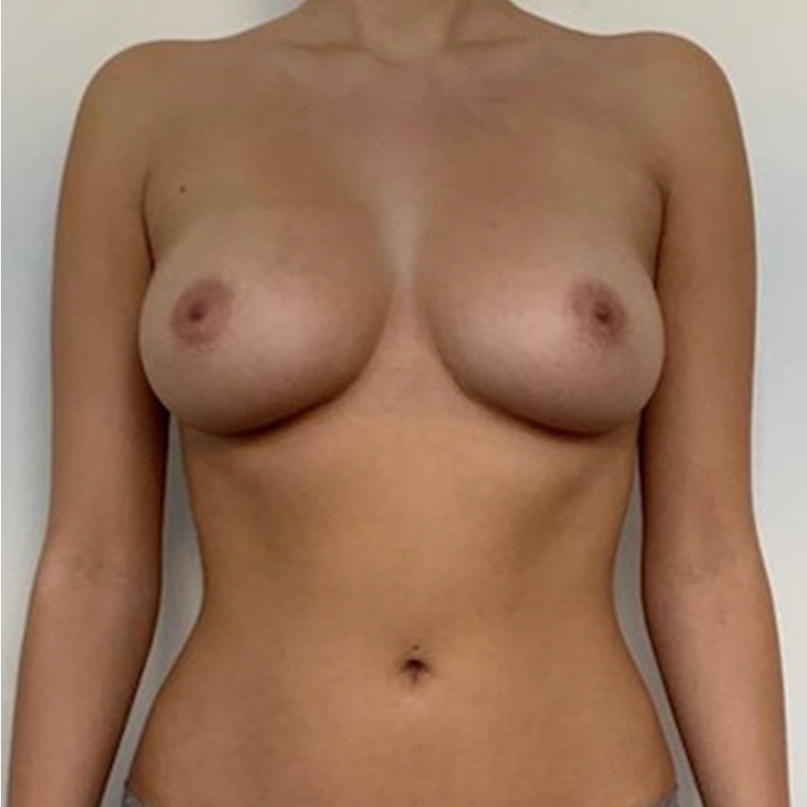 BFO lipoinjektion efter