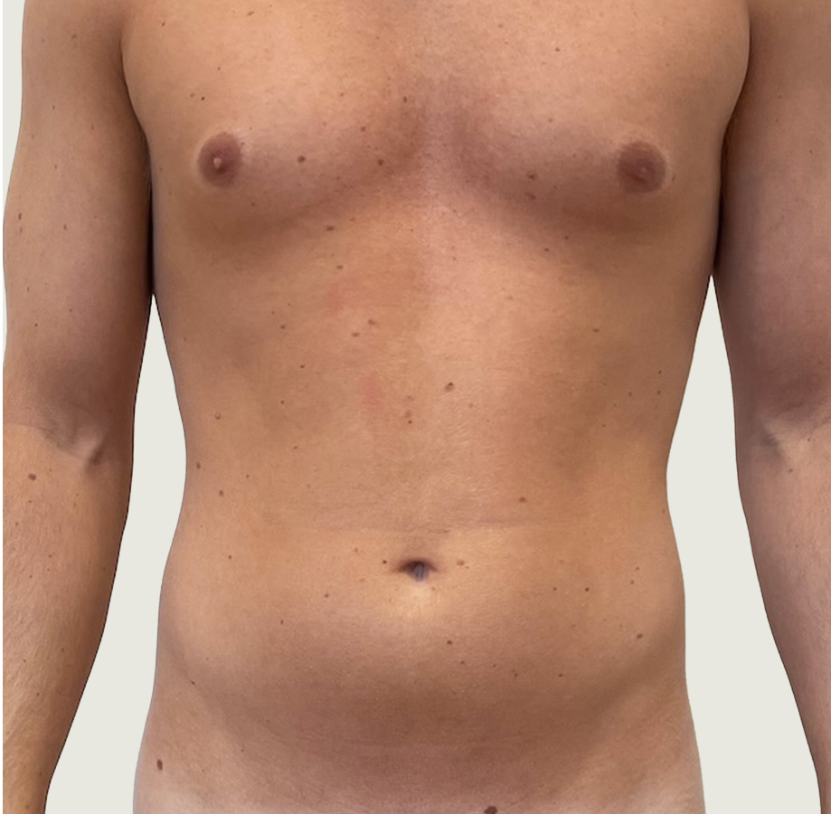Liposculpture mand før forfra