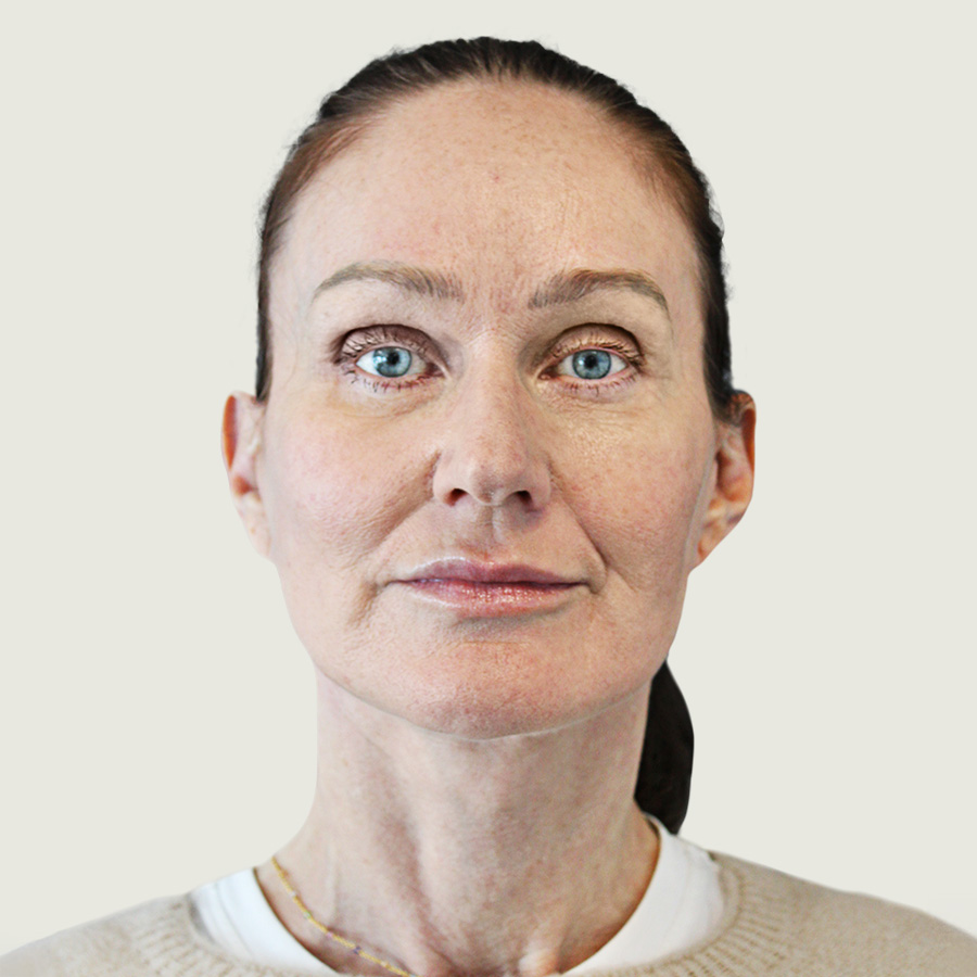 Deep plane necklift efter