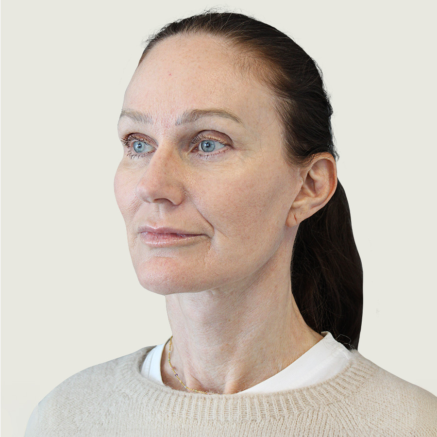 Deep plane necklift efter