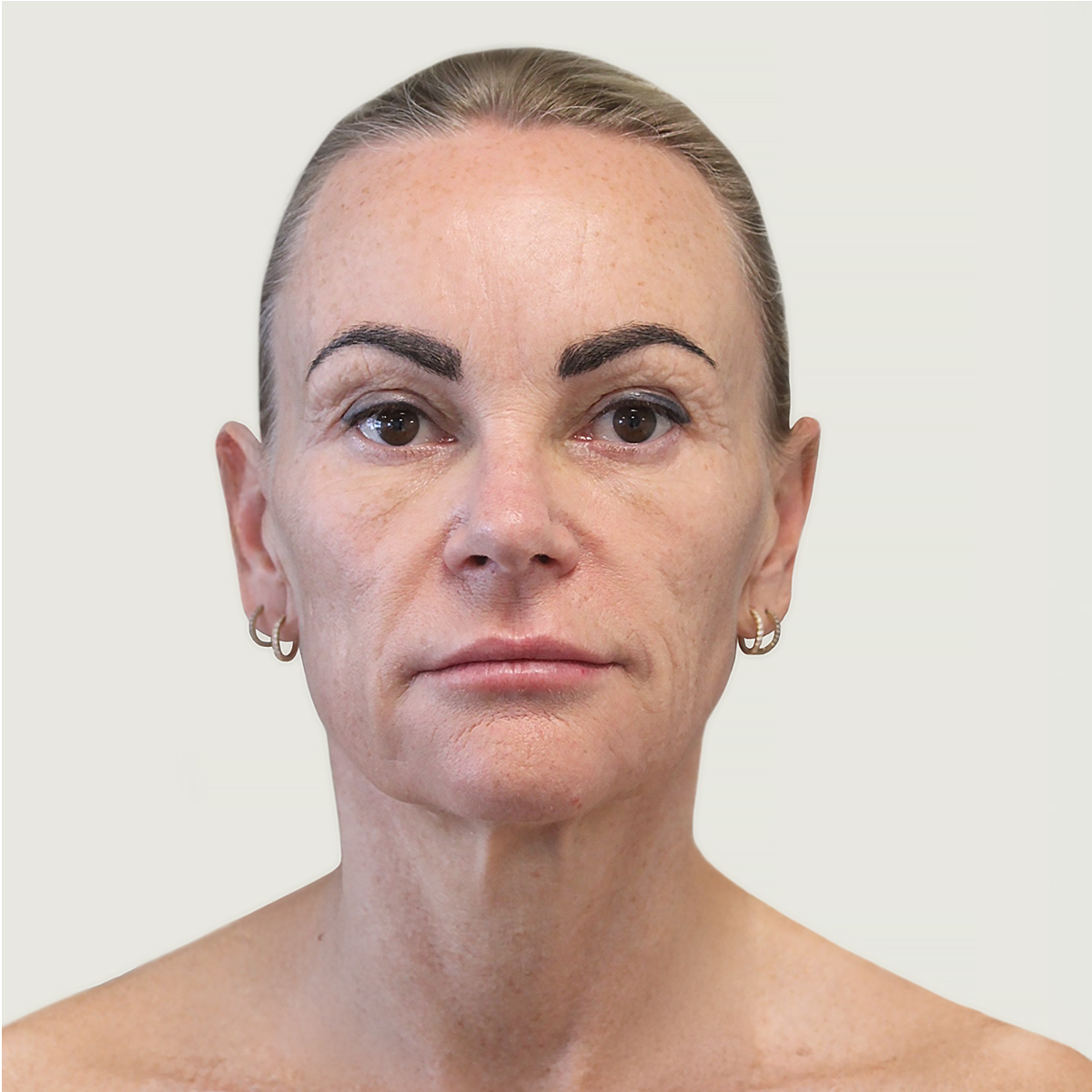 Deep plane necklift før fofra