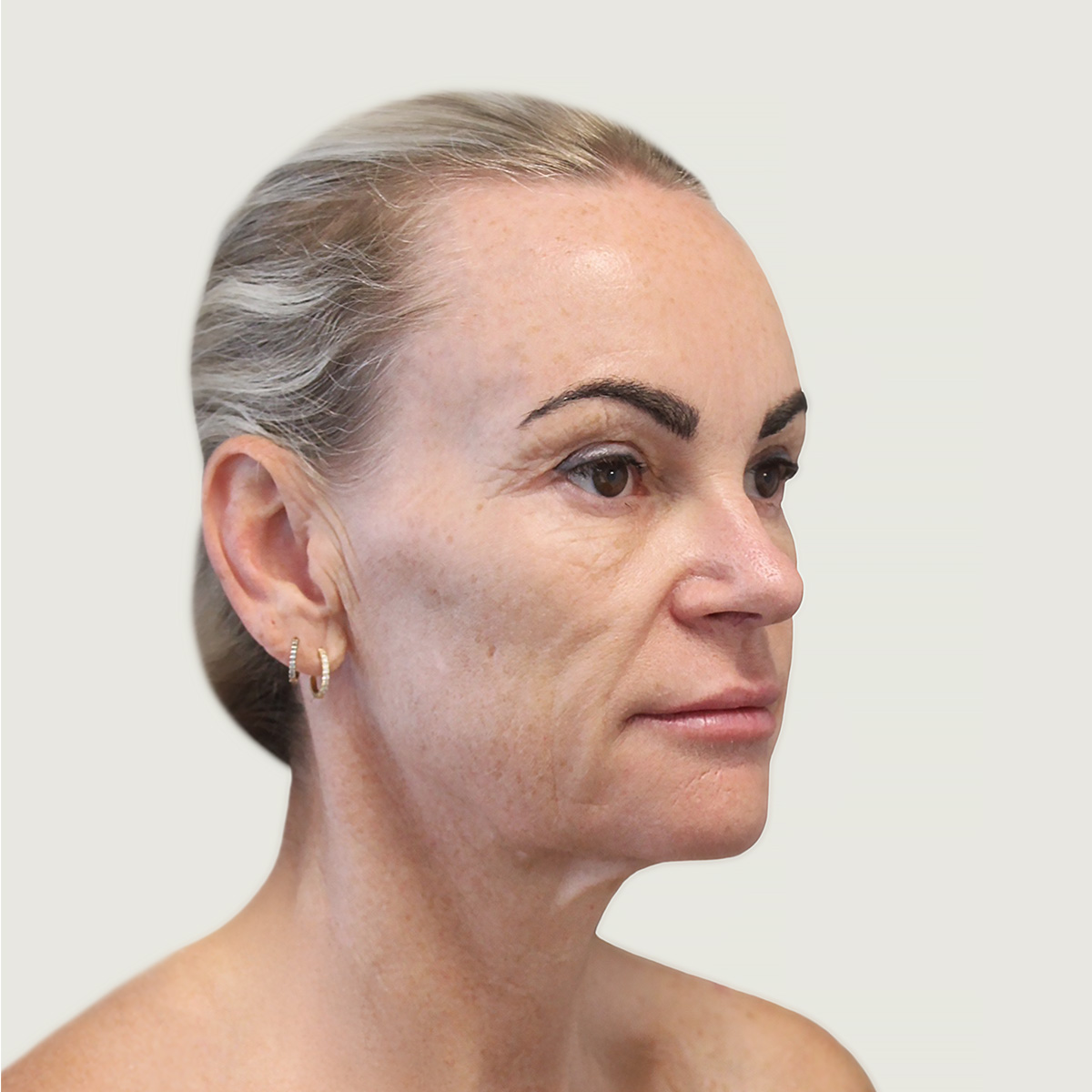 Deep plane necklift før