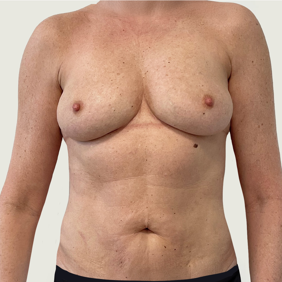 Fjernelse af implantater & erstatning med eget fedtvæv efter