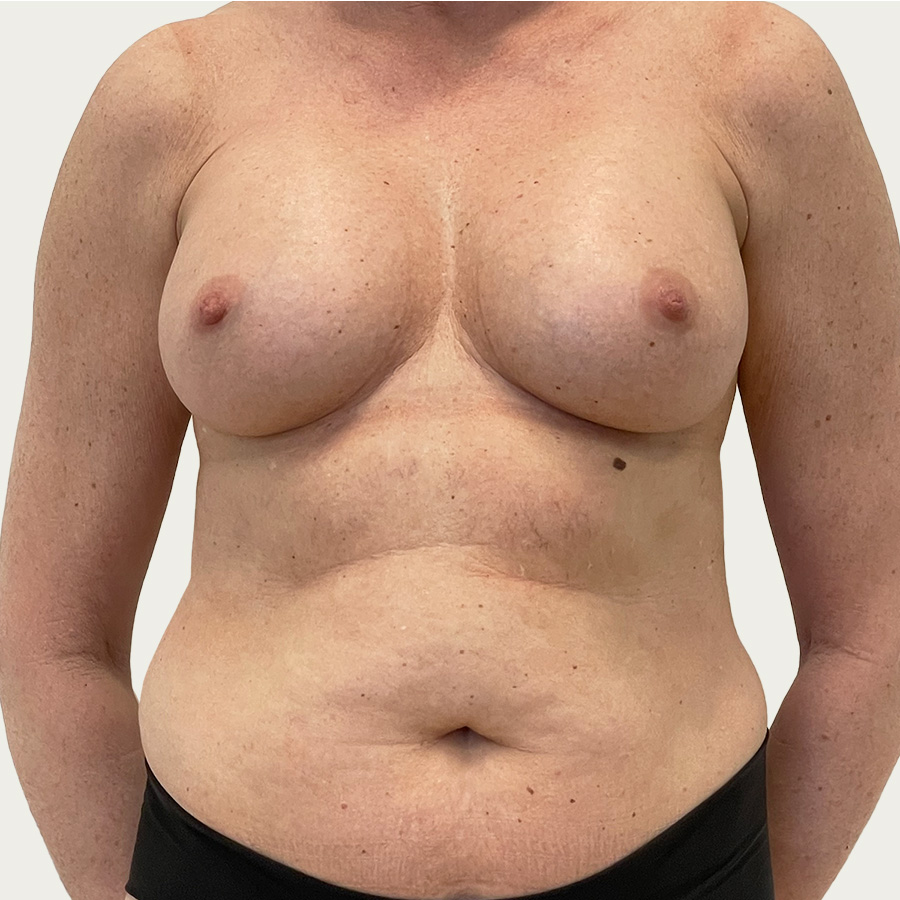 Fjernelse af implantater & erstatning med eget fedtvæv før