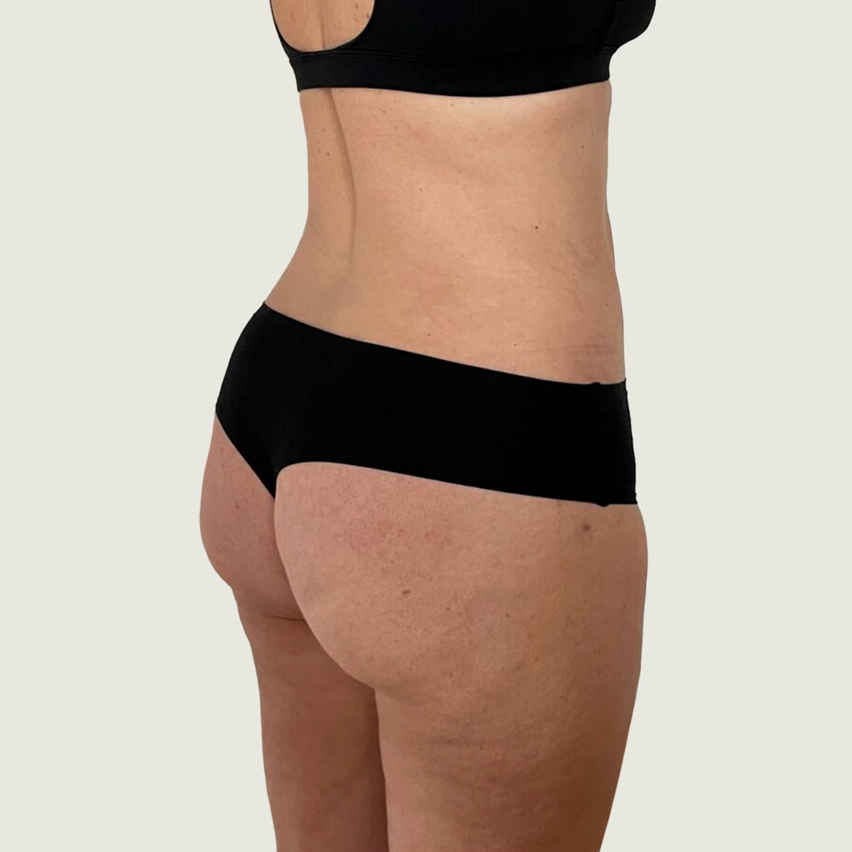 Liposuction efter
