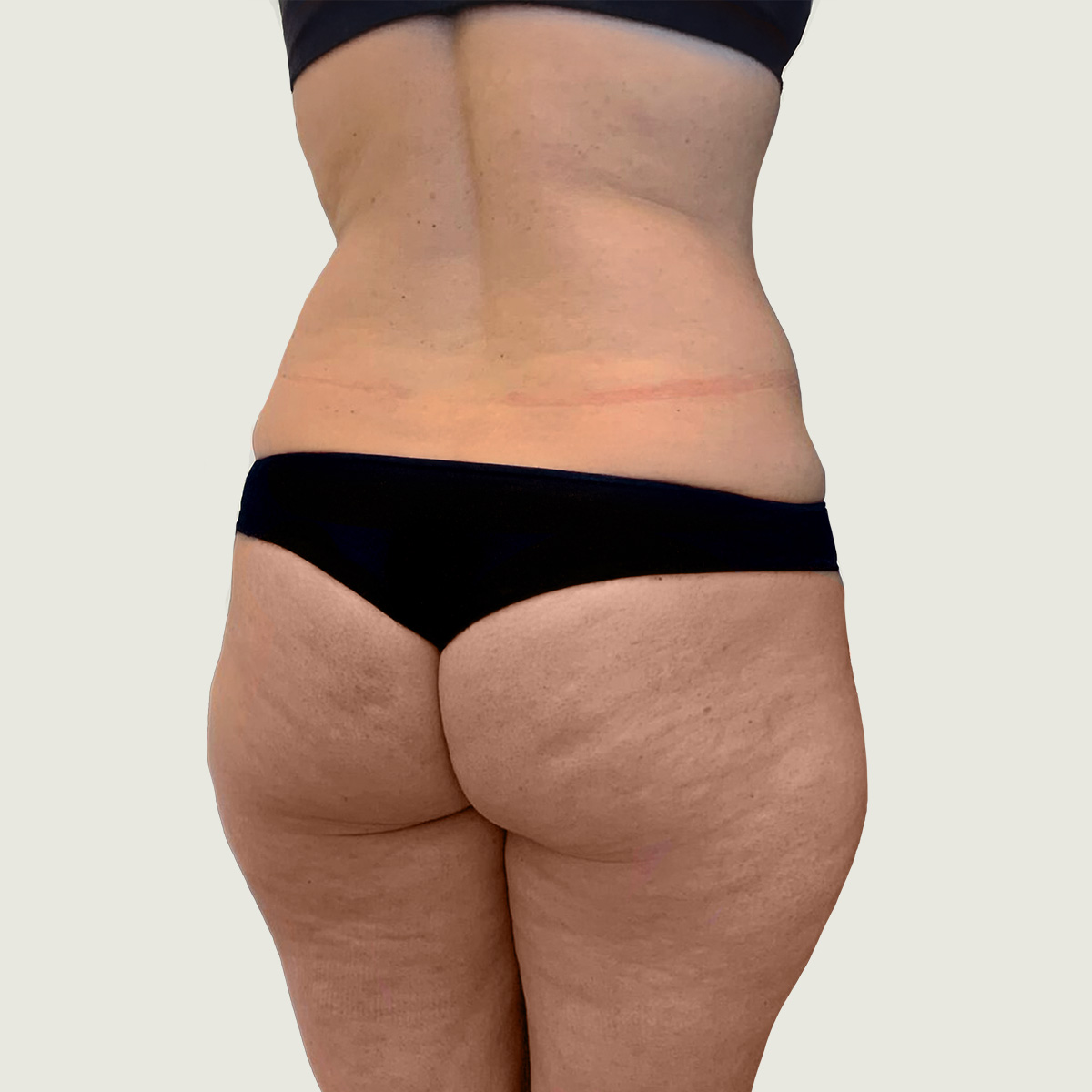 Liposuction før