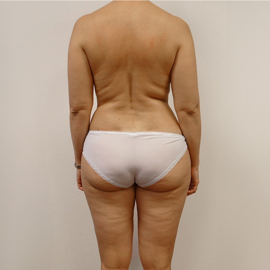 Før Bodycontouring bagfra