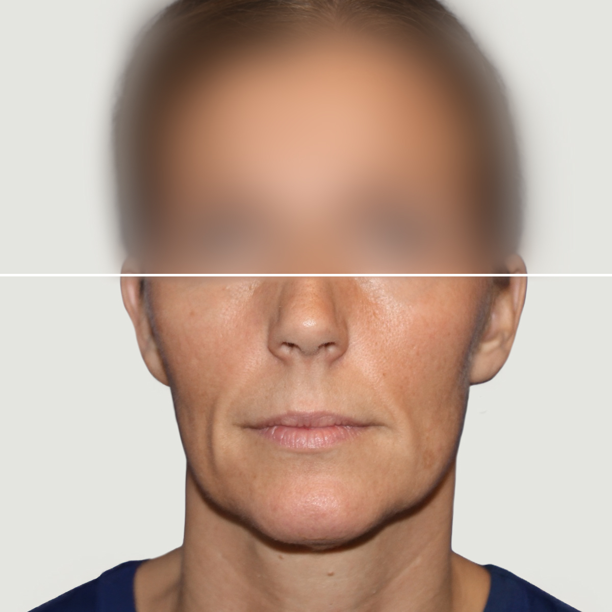 Før Lipofilling til korrektion af fylde og hudkvalitet