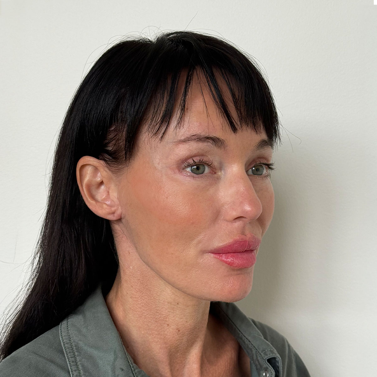 Efter Deep plane facelift fra siden