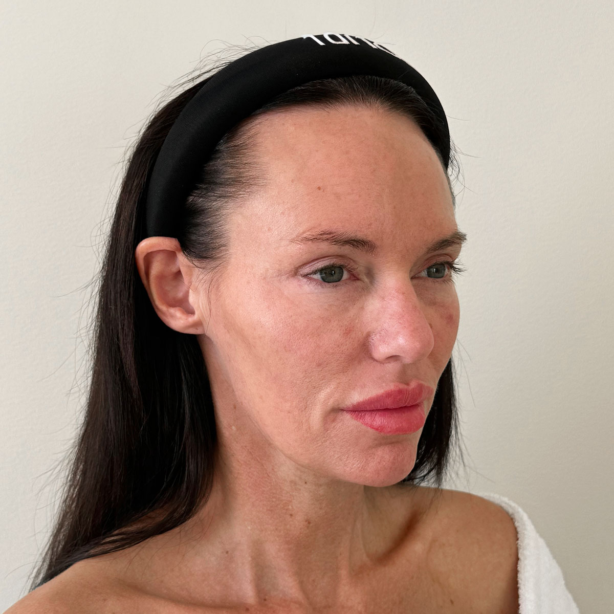 Før Deep plane facelift fra siden