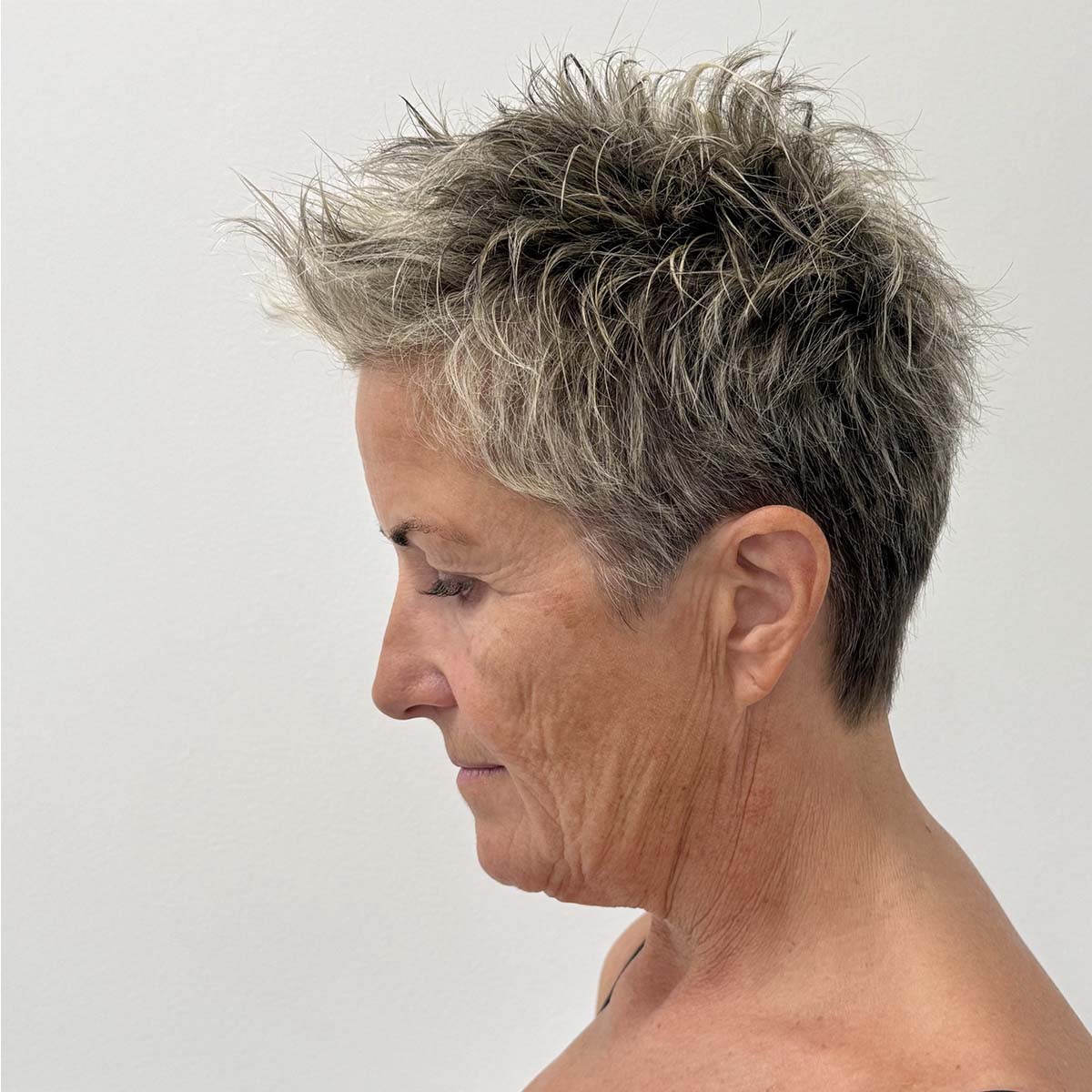 Før Deep plane facelift og Deep plane necklift fra siden