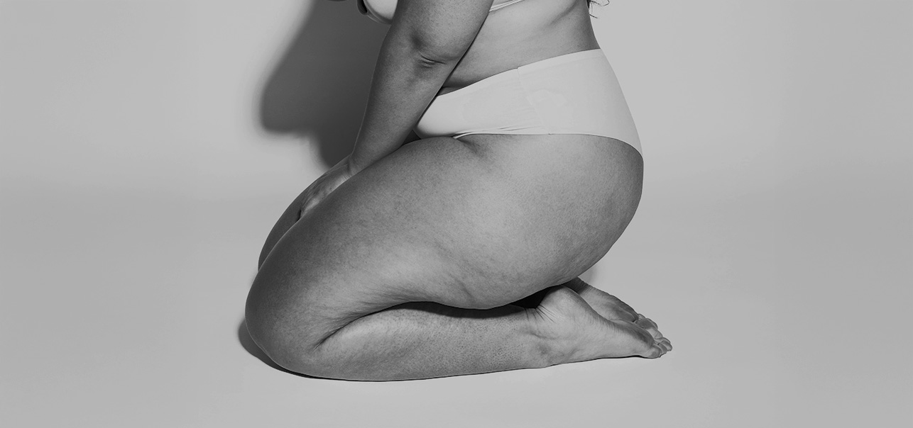 Lipoedema-behandling kvinde fra siden